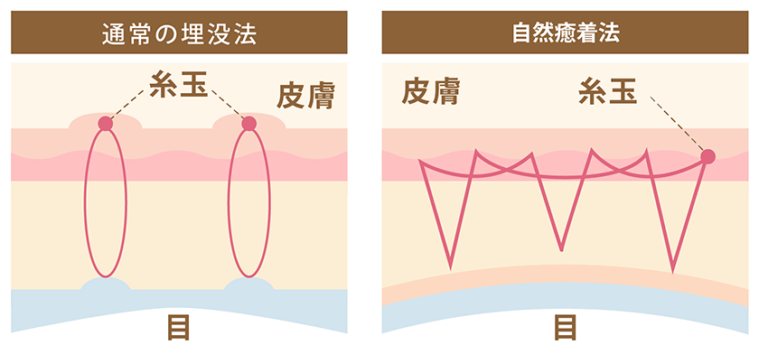 通常の埋没法と自然癒着法の違い