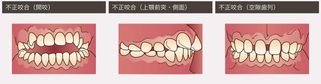 子供の歯並びが悪くなる癖とは？