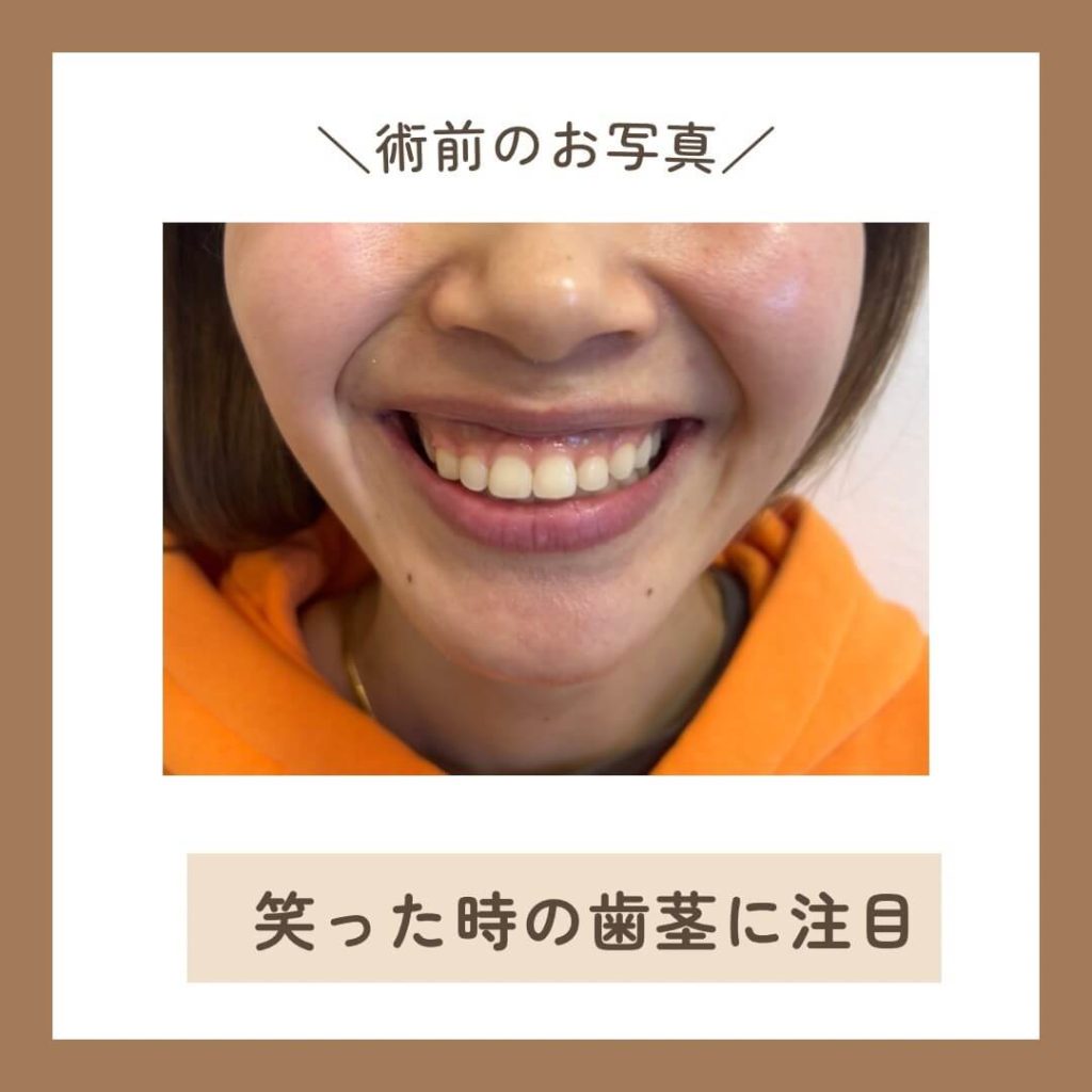 歯茎が目立つガミースマイルの治療について