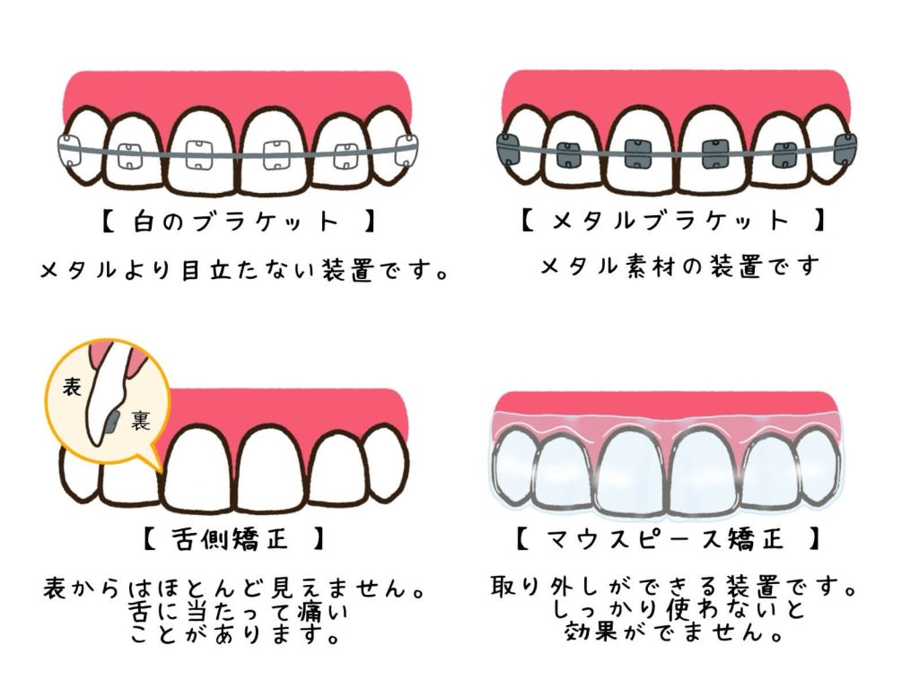 目立ちにくい歯列矯正はぜひ当院へ