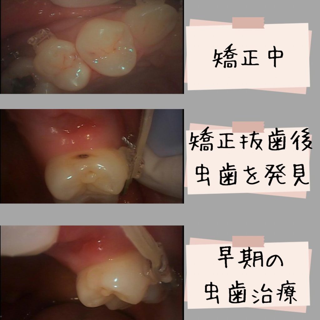 前歯が重なり合ってデコボコ。虫歯になりやすい？〜 恵比寿、伊勢原のピュアグループ〜