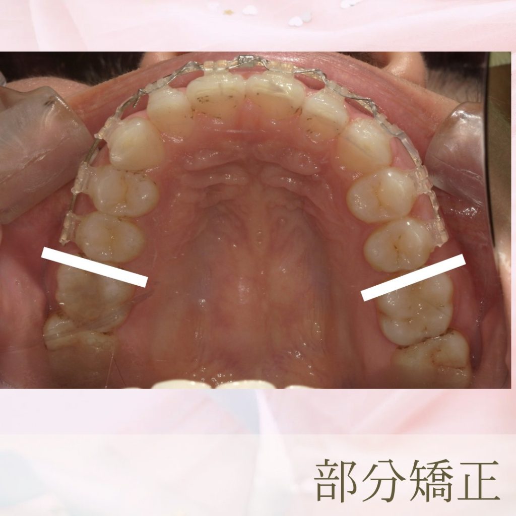 歯列矯正を最短でやるには?〜 恵比寿、伊勢原のピュアグループ〜