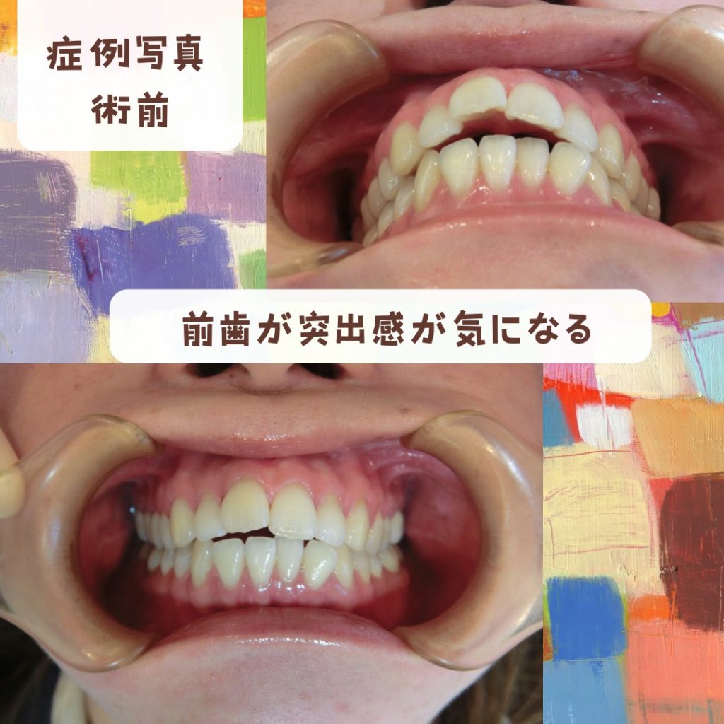 出っ歯が気になります　矯正歯科治療の費用はどのくらいかかる？〜 恵比寿、伊勢原のピュアグループ〜