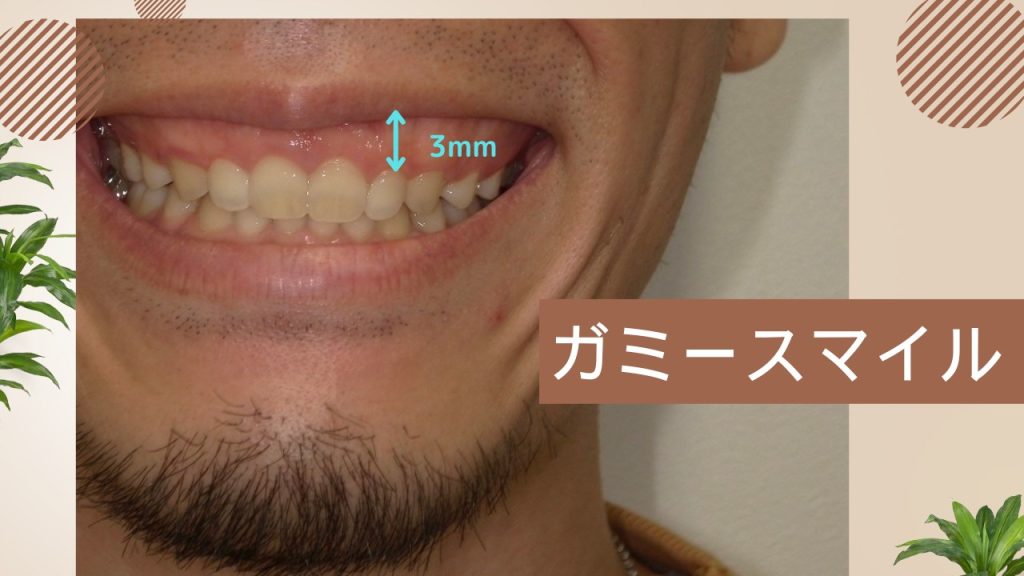 ガミースマイル治療について症状や原因、治療法まとめ