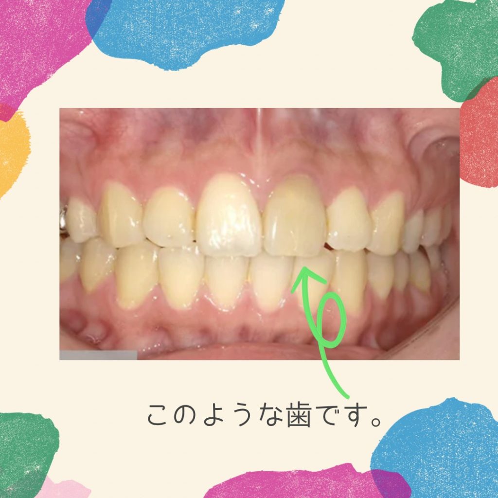 歯が黒い方はどうしたらいい？？」～恵比寿・伊勢原　歯科歯医者のPUREグループ～