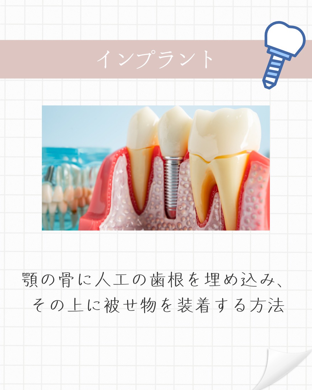 歯の根が割れてしまったら？「歯根破折」とその後の選択肢 | 恵比寿の