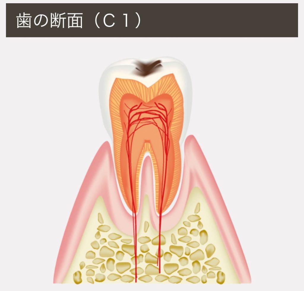 虫歯放置してませんか?