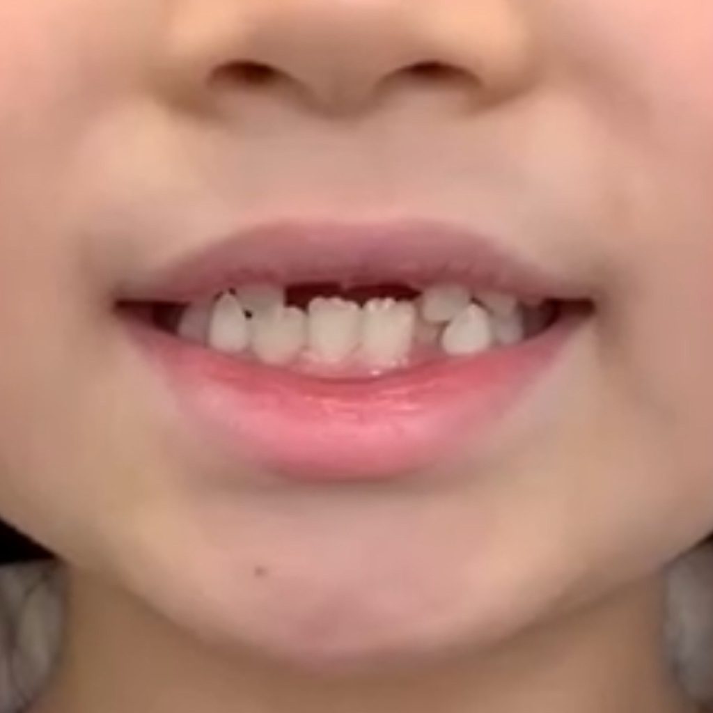お子様の仮歯について